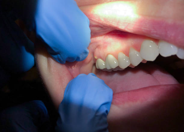 Best Emergency Broken Tooth Repair in Espy, PA